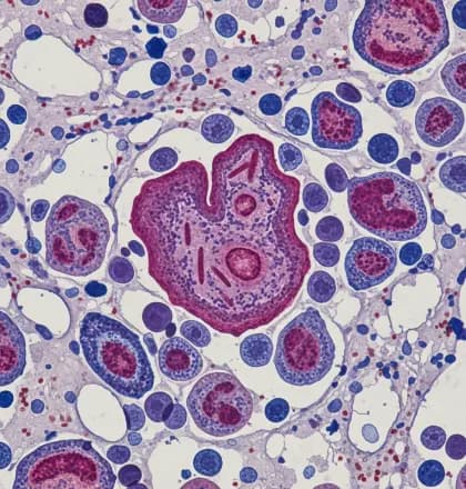 AML: Rethinking Intensive Therapy for Myelodysplasia-Related & Therapy-Related Subtypes
