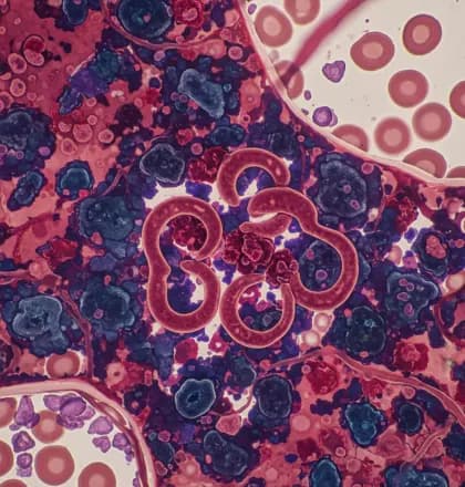 Inflammation Drives Sickle Cell Disease Pathophysiology