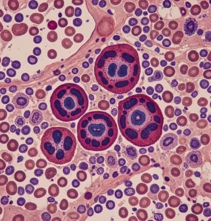 Novel Approaches in R/R MM: Expert Perspectives from EHA 2026