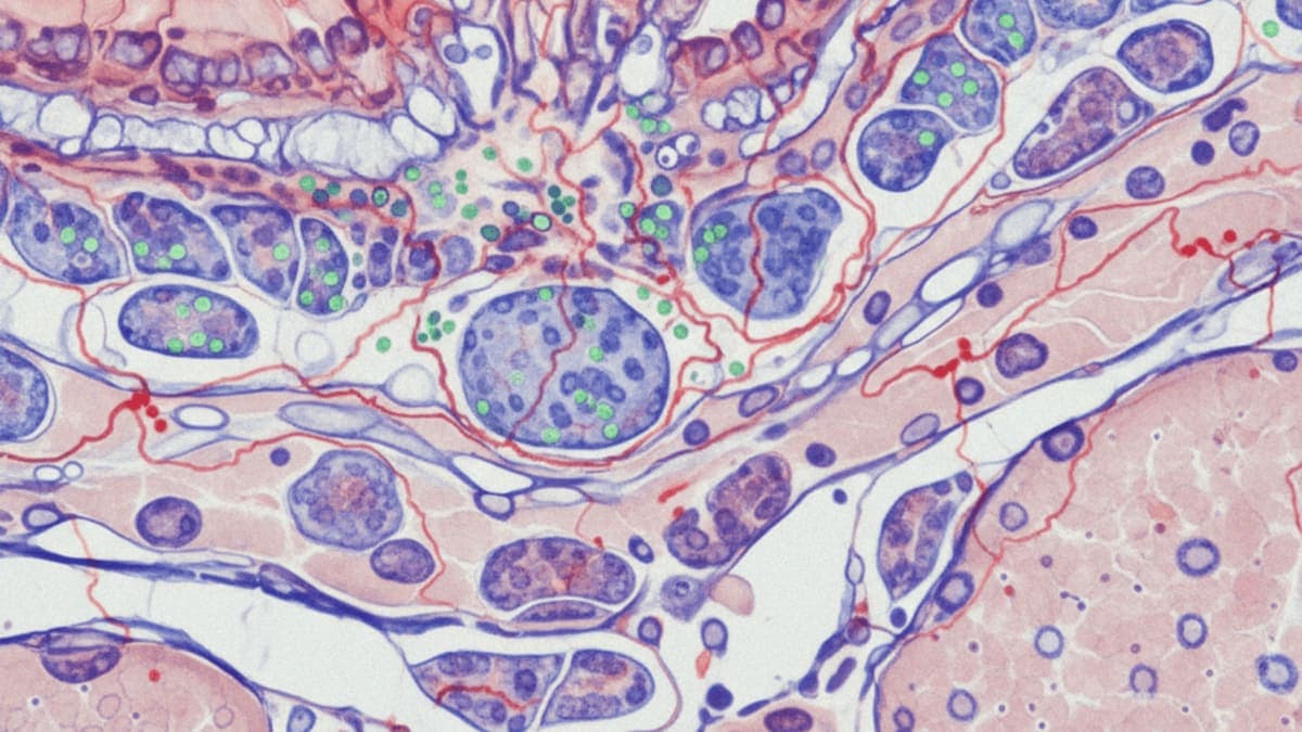 unraveling-ichthyosis-immunodeficiency-linkages