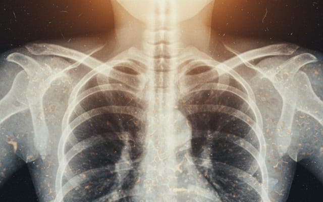 systemic-sclerosis-and-tb-what-to-watch-for
